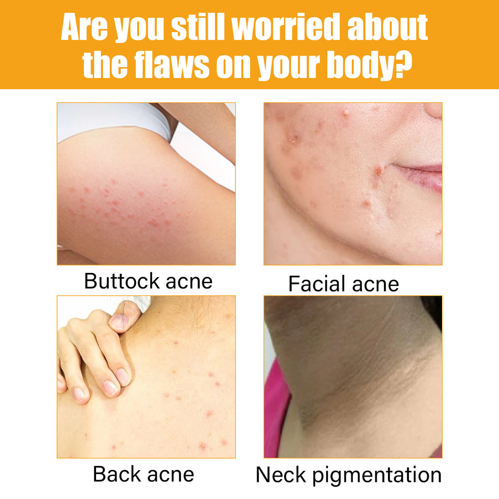 (SPECIAL!)Acne Treatment Essence for all body parts