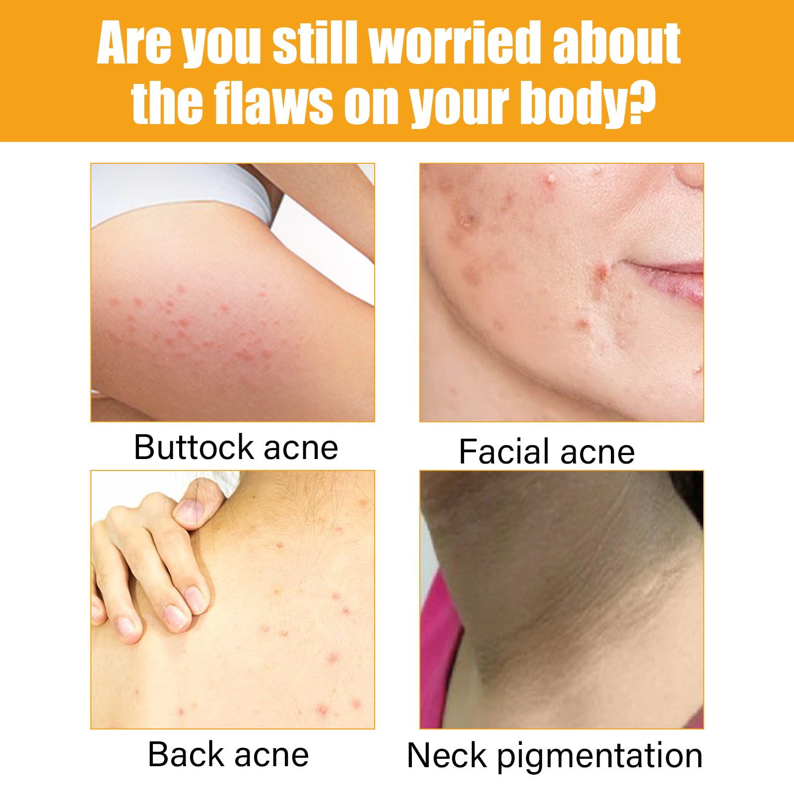 (SPECIAL!)Acne Treatment Essence for all body parts
